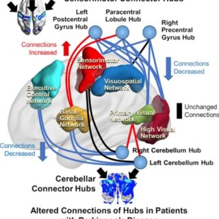 Altered hub connections in patients with PD