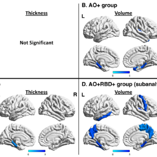Longitudinal brain changes in Parkinson’s disease with severe olfactory deficit
