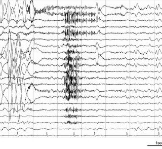 EEG data (seizure onset)